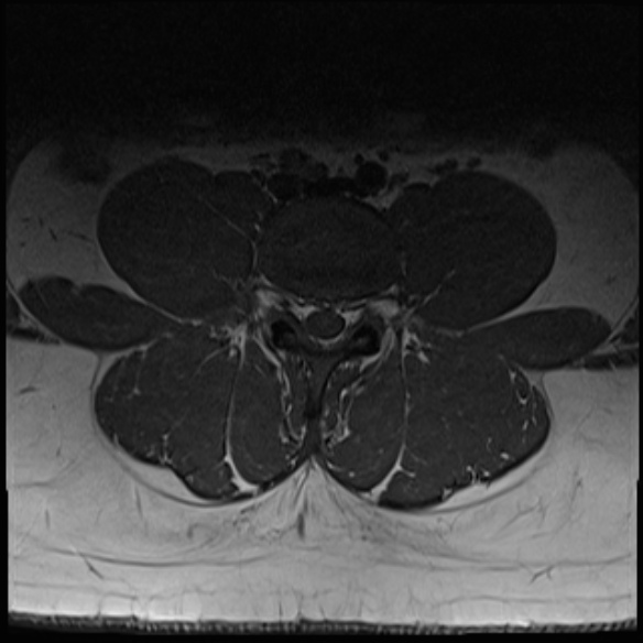 File:Normal lumbar spine MRI (Radiopaedia 47857-52609 Axial T1 15).jpg
