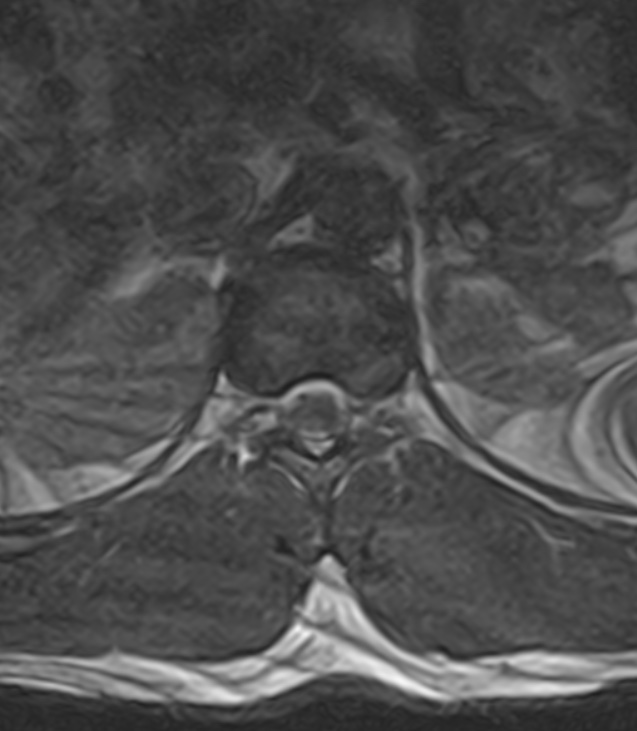 Normal lumbar spine MRI - low-field MRI scanner (Radiopaedia 40976-43699 Axial T2 5).jpg