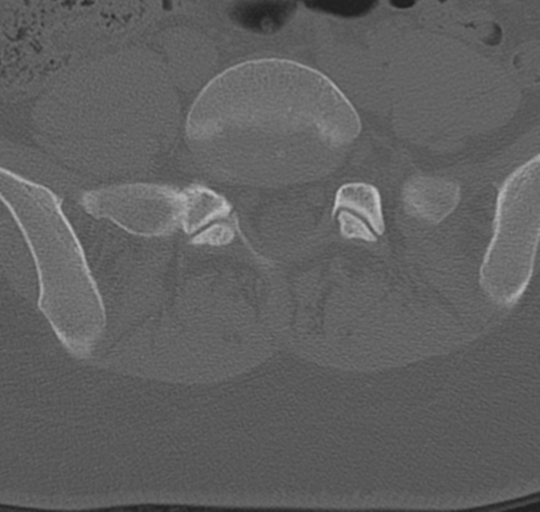 File:Normal lumbosacral CT (Radiopaedia 37923-39867 Axial bone window 78).png