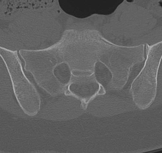 File:Normal lumbosacral CT (Radiopaedia 37923-39867 Axial bone window 85).png