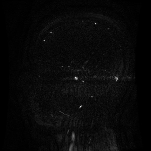 Normal noncontrast MR venography (Radiopaedia 87578-103957 A 62).jpg