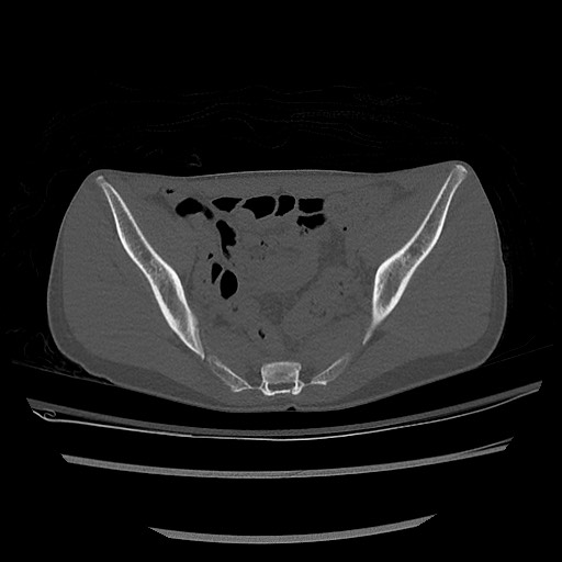 Normal pelvis CT (Radiopaedia 51471-57236 Axial bone window 46).jpg