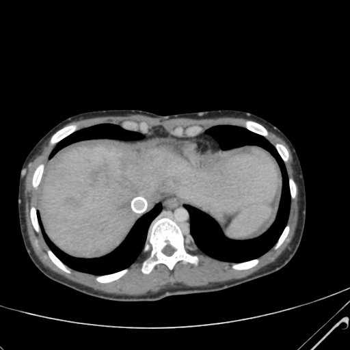 File:Nutmeg liver- Budd-Chiari syndrome (Radiopaedia 46234-50635 B 8).png