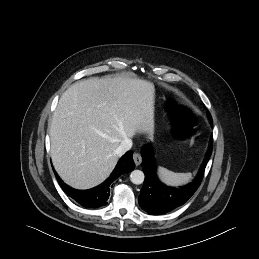 File:Obstructing sigmoid adenocarcinoma (Radiopaedia 58465-65619 A 26).jpg