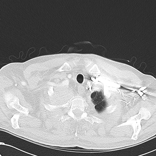 File:Obstructive superior vena cava tumor thrombus (Radiopaedia 28046-28306 Axial lung window 5).jpg