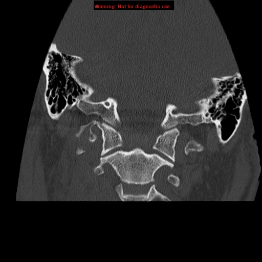 File:Occipital condyle fracture (Radiopaedia 18366-18208 Coronal bone window 12).jpg