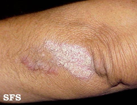 File:Psoriasis (Dermatology Atlas 1).jpg