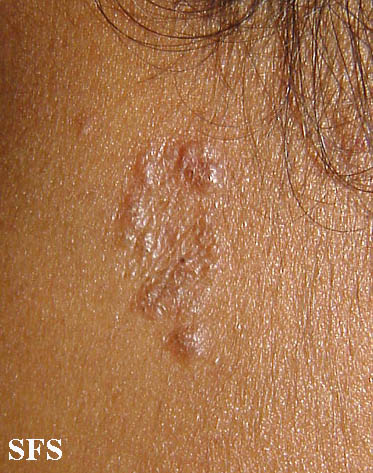 File:Sarcoidosis (Dermatology Atlas 6).jpg