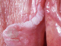File:Vulval cancer (DermNet NZ site-age-specific-vin3-s).jpg
