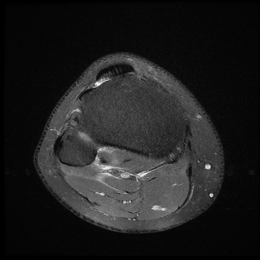 File:ACL acute full thickness tear - deep lateral femoral sulcus sign (Radiopaedia 38594-40740 Axial PD fat sat 22).jpg