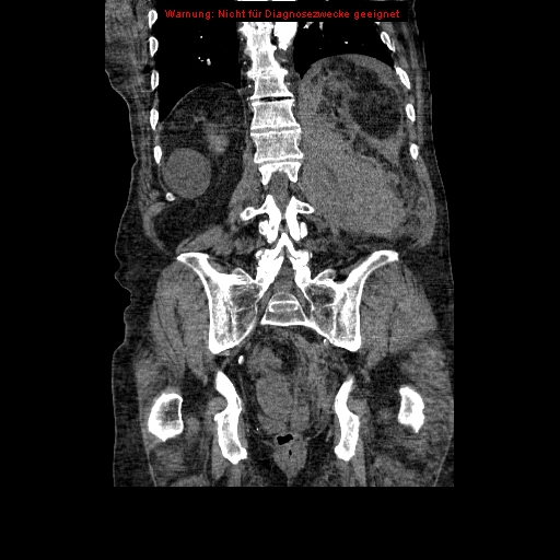 File:Abdominal aortic aneurysm- extremely large, ruptured (Radiopaedia 19882-19921 Coronal C+ arterial phase 77).jpg