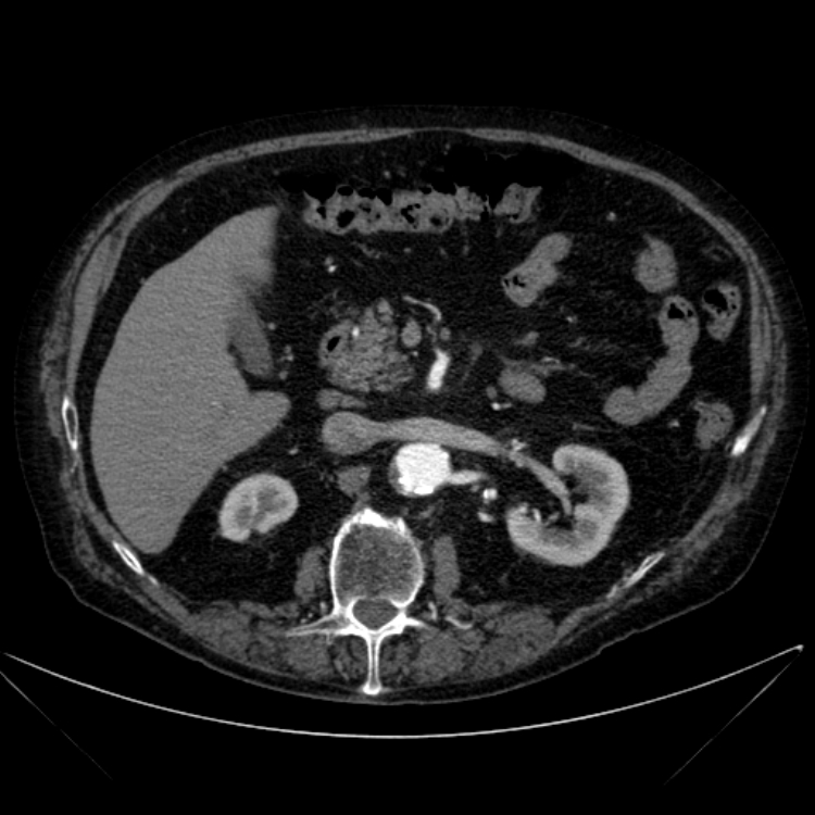Abdominal aortic aneurysm (Radiopaedia 25855-26001 Axial C+ arterial phase 50).jpg