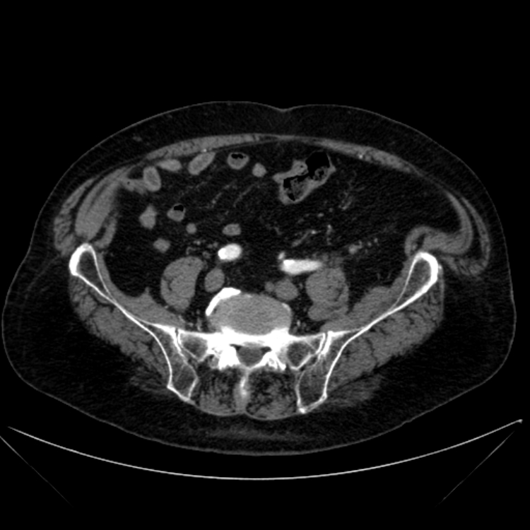 Abdominal aortic aneurysm (Radiopaedia 25855-26001 Axial C+ arterial phase 98).jpg