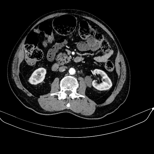 Abdominal aortic aneurysm (Radiopaedia 67117-76452 Axial C+ arterial phase 64).jpg