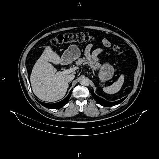 Abdominal aortic aneurysm (Radiopaedia 83094-97462 Axial renal excretory phase 34).jpg
