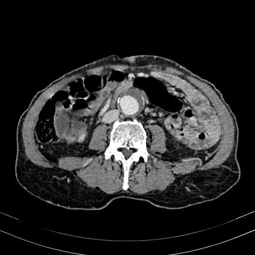 Abdominal aortic aneurysm (Radiopaedia 83581-98689 Axial C+ portal venous phase 63).jpg