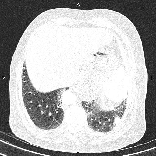 Abdominal aortic aneurysm (Radiopaedia 85063-100606 Axial lung window 54).jpg