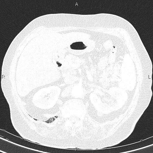 Abdominal aortic aneurysm (Radiopaedia 85063-100606 Axial lung window 67).jpg