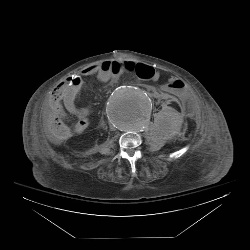 Abdominal aortic aneurysm - impending rupture (Radiopaedia 19233-19247 Axial non-contrast 101).jpg