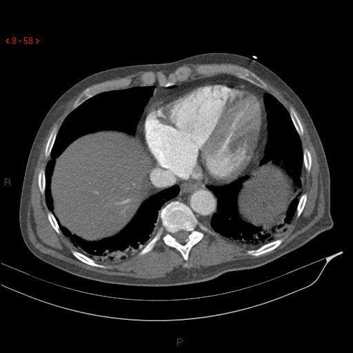 File:Abdominal aortic aneurysm rupture with aortocaval fistula (Radiopaedia 14897-14841 Axial C+ arterial phase 58).jpg