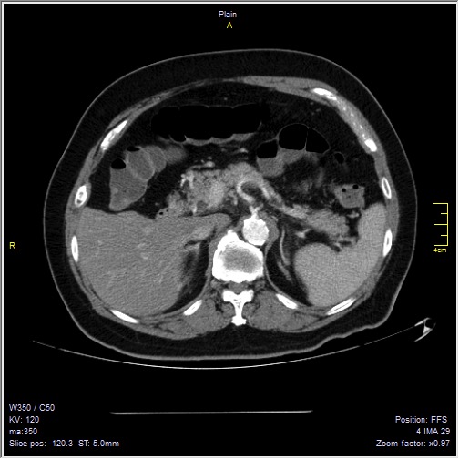 Abdominal aortic aneurysm with thrombus fissuration (Radiopaedia 47340-51926 Axial C+ arterial phase 13).jpg