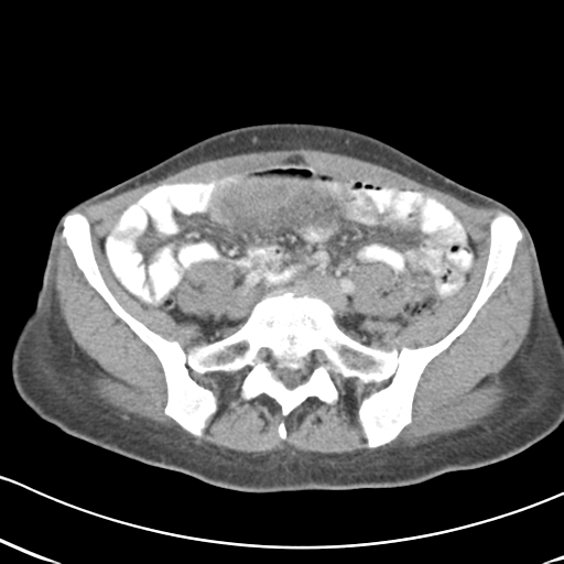 Abdominal desmoid tumor (Radiopaedia 41007-43740 Axial C+ portal venous phase 49).png