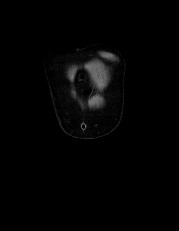 Abdominal lymphoma - with sandwich sign (Radiopaedia 53486-59492 C+ portal venous phase 59).jpg