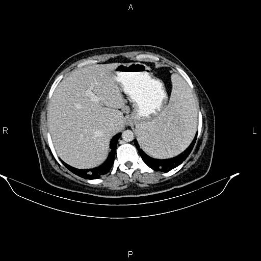 Abdominal lymphoma with sandwich sign (Radiopaedia 84378-99704 Axial C+ portal venous phase 10).jpg