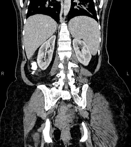 Abdominal lymphoma with sandwich sign (Radiopaedia 84378-99704 Coronal C+ portal venous phase 48).jpg