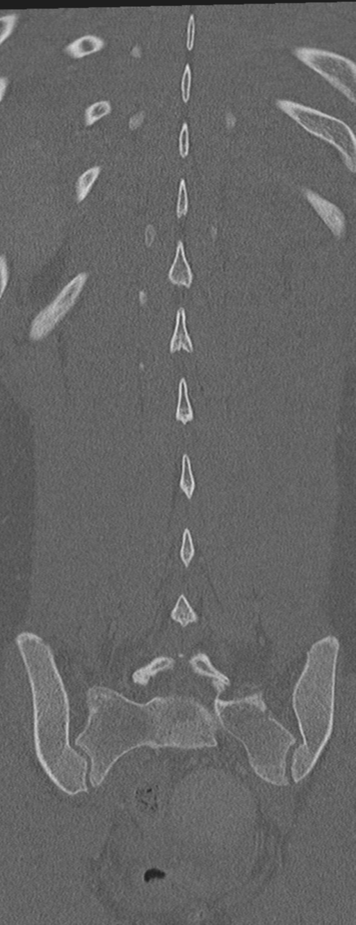 Abdominal multi-trauma - devascularised kidney and liver, spleen and pancreatic lacerations (Radiopaedia 34984-36486 Coronal bone window 55).png