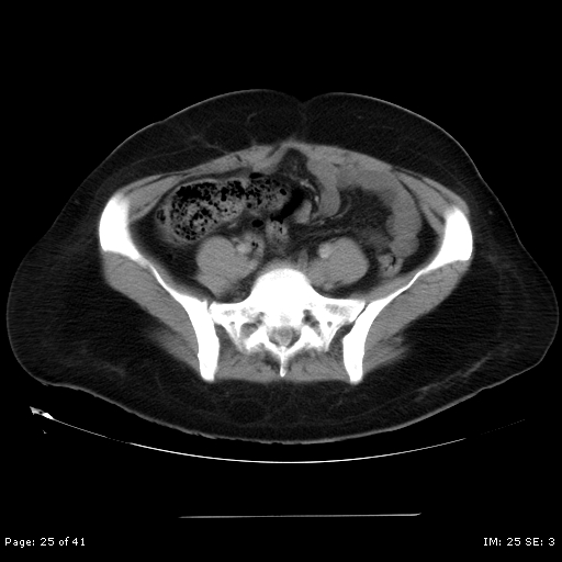 File:Abdominal wall endometriosis (Radiopaedia 25723-25885 Axial C+ portal venous phase 25).jpg