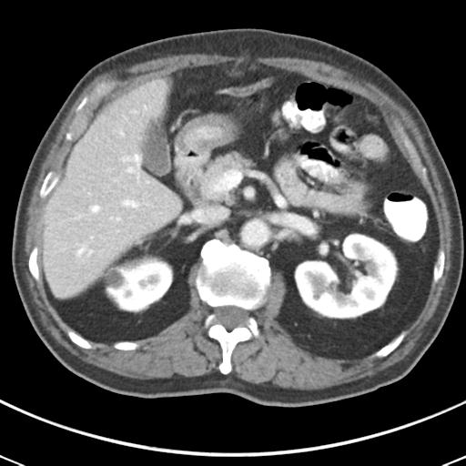Abdominal wall metastasis from colorectal carcinoma (Radiopaedia 31016-31717 Axial C+ portal venous phase 26).jpg