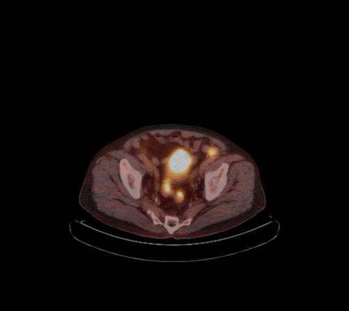 Abdominal wall metastasis from colorectal carcinoma (Radiopaedia 31016-31719 C 33).jpg