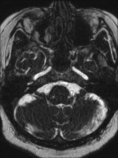 Abducens nerve palsy (Radiopaedia 57084-63976 Axial T2 ciss 3d 18).jpg