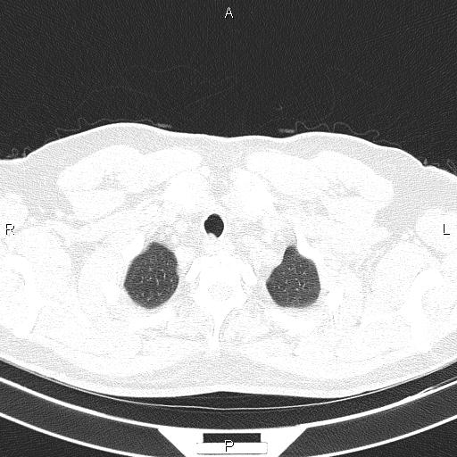 Aberrant right subclavian artery (Radiopaedia 87093-103354 Axial lung window 12).jpg