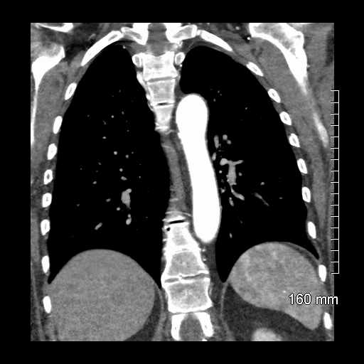 Aberrant right subclavian artery stenosis (Radiopaedia 52656-58670 B 60).jpg