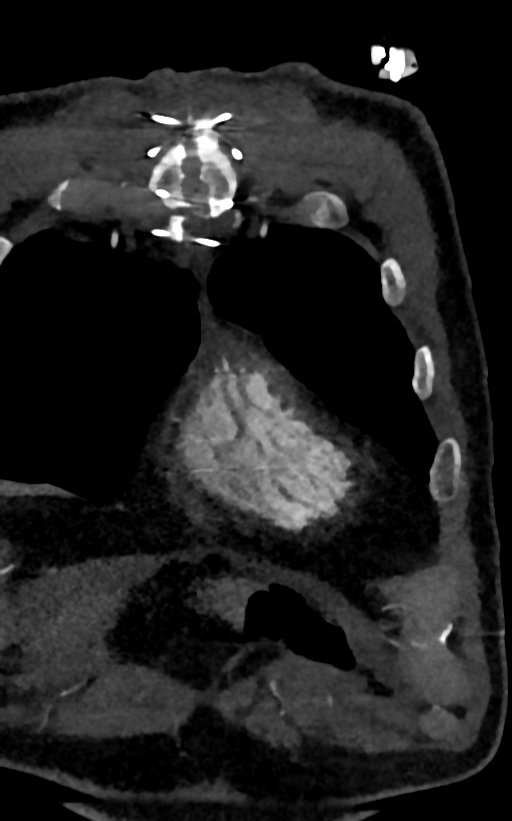 Accessory left atrial appendage (Radiopaedia 81987-95968 Coronal C+ arterial phase 1).jpg