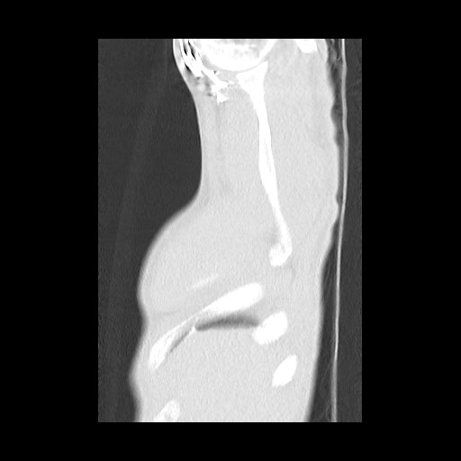 Accessory left horizontal fissure with lingular pneumonia (Radiopaedia 53763-59843 Sagittal lung window 7).jpg