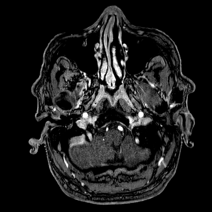 Accessory middle cerebral artery (Radiopaedia 73114-83828 Axial MRA 9).jpg