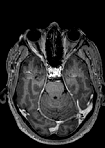 Accessory middle cerebral artery (Radiopaedia 73114-83828 Axial T1 C+ 96).jpg