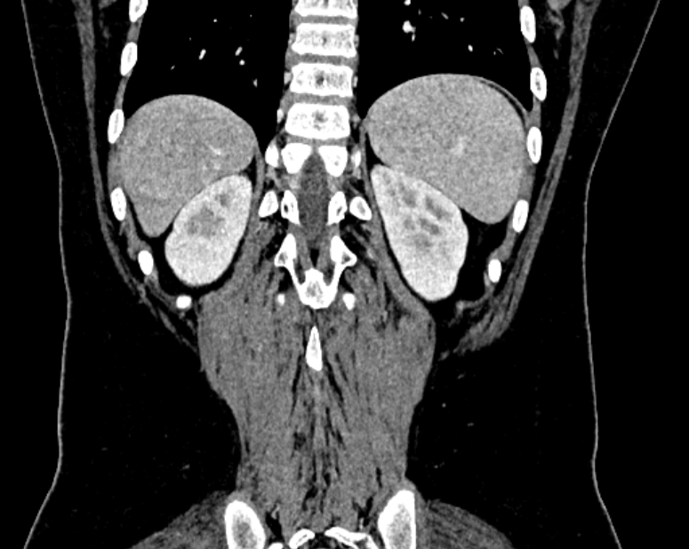 Accessory right inferior hepatic vein (Radiopaedia 75207-86305 Coronal C+ portal venous phase 66).jpg
