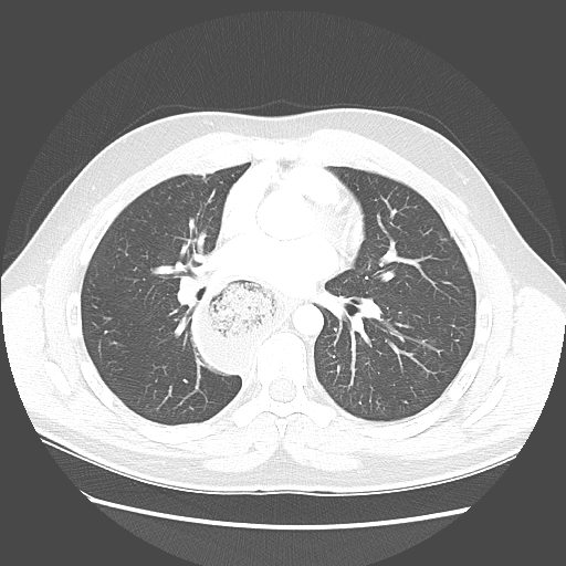 Achalasia (Radiopaedia 52507-58417 Axial lung window 33).jpg
