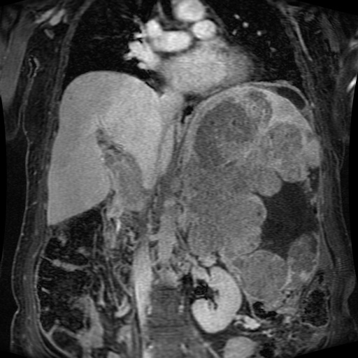 Acinar cell carcinoma of the pancreas (Radiopaedia 75442-86668 Coronal T1 C+ fat sat 97).jpg