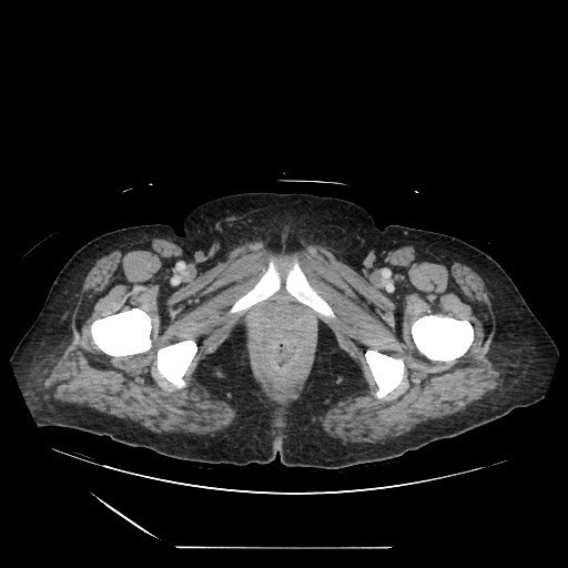 Acinar cell carcinoma of the pancreas (Radiopaedia 75442-86669 Axial C+ portal venous phase 153).jpg