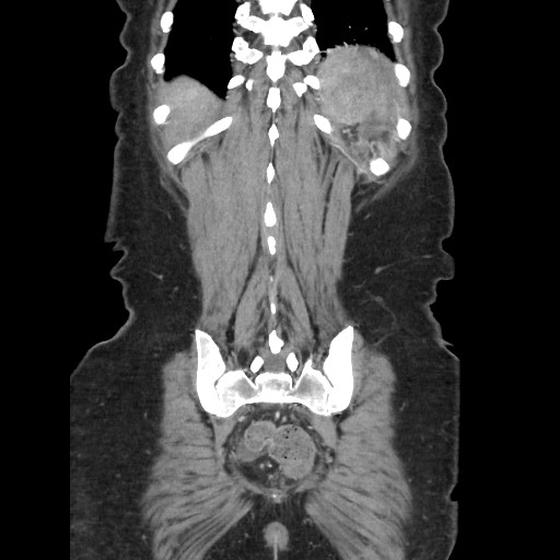File:Acinar cell carcinoma of the pancreas (Radiopaedia 75442-86669 Coronal C+ portal venous phase 108).jpg