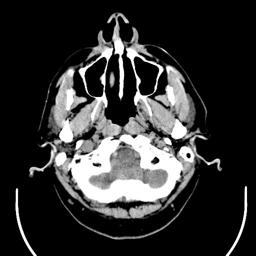 File:Acoustic schwannoma (Radiopaedia 29488-29982 AXIAL THICK non-contrast 4).jpg