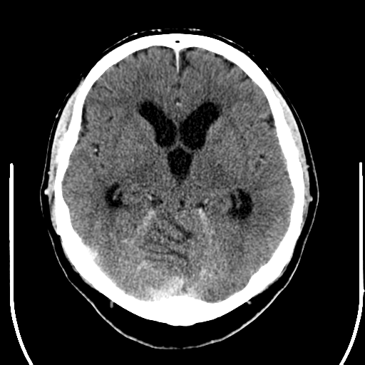 File:Acoustic schwannoma (Radiopaedia 39170-41389 Axial C+ 12).png