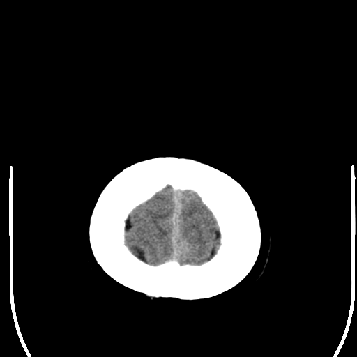 File:Acoustic schwannoma (Radiopaedia 39170-41389 Axial non-contrast 28).png