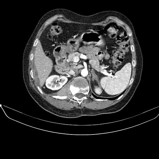 File:Acquired adrenal hyperplasia - due to thymic carcinoid tumor (Radiopaedia 21269-21184 C+ arterial phase 36).jpg