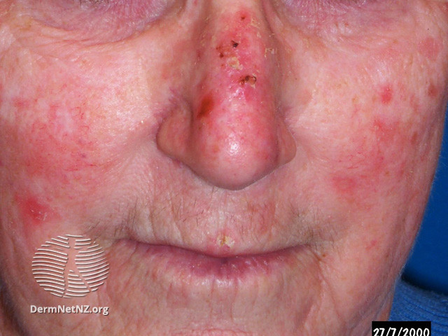 Actinic Keratoses affecting the face (DermNet NZ lesions-ak-face-454).jpg